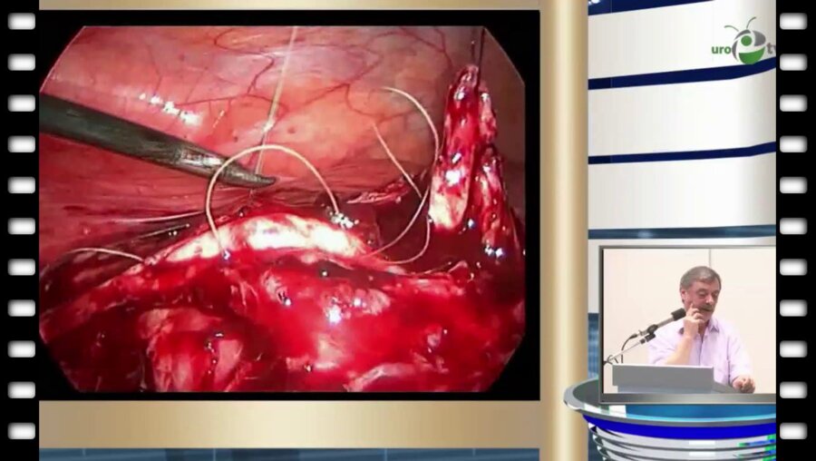 С.Г. Бондаренко - Лапароскопическая лоскутная пиелопластика при сложный формах гидронефроза у детей