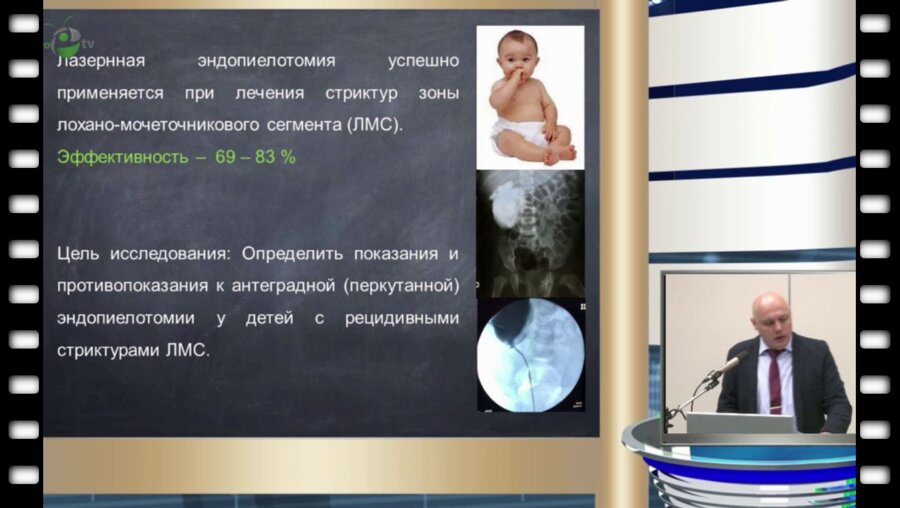 Л.Д. Арустамов - Антеградная лазерная эндопиелотомия в лечении рецидивной стриктуры лохано-мочеточникового сегмента у детей