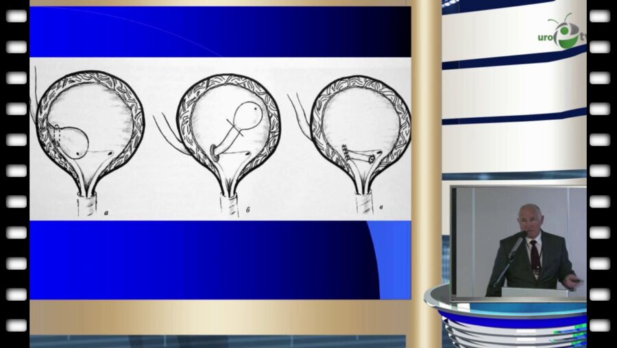 П.И. Чумаков - Внутрипузырная пластика устья мочеточника при ортотопическом уретероцеле больших размеров у детей