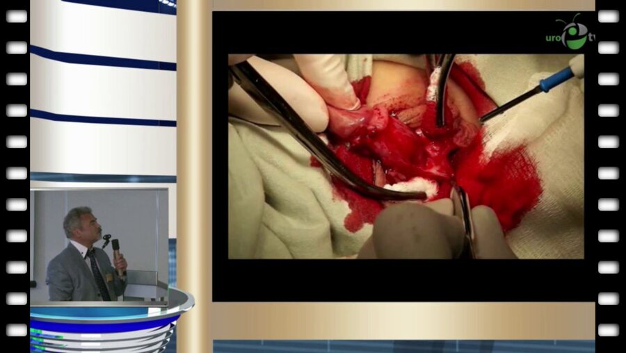 А.К Файзулин - Способ коррекции проксимальной формы гипоспадии по методике «onlay-tubc-onlay» (ОТО) и «onlay-tube»