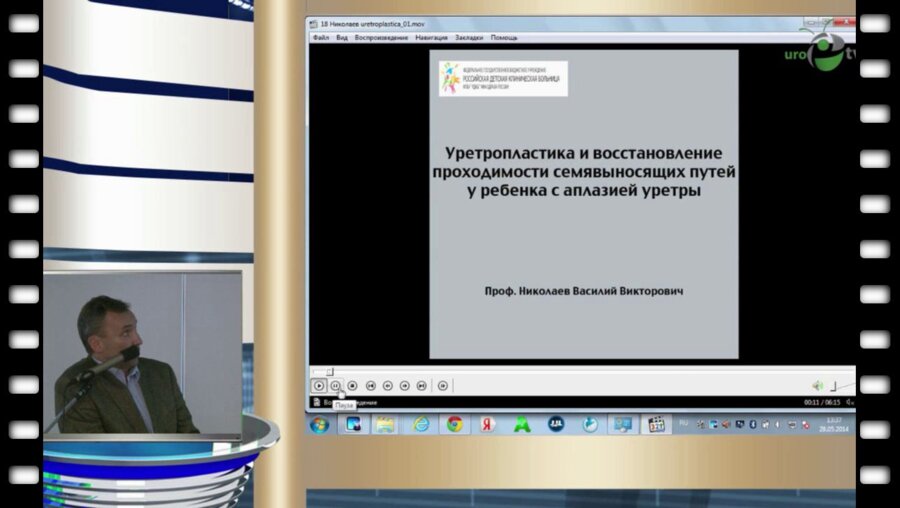 В.В. Николаев - Аплазия задней уретры у мальчика - формирование задней уретры с восстановлением проходимости семявыносящих путей
