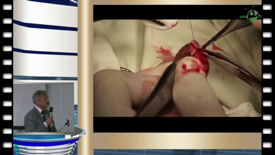 А.К. Файзулин - Хирургическое лечение детей с ятрогенными повреждениями кавернозных тел полового члена