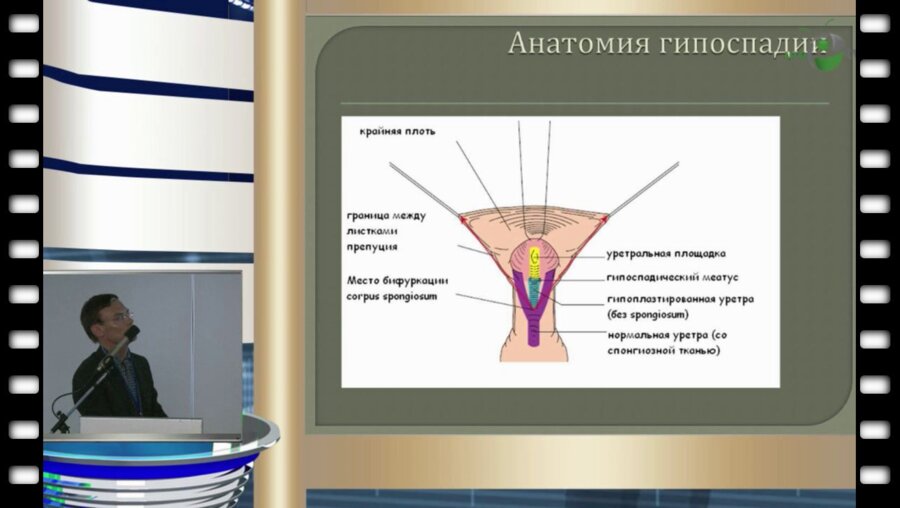 Р.Т. Батрутдинов - Уретропластика Duplay-Snodgrass в сочетании с препуциопластикой