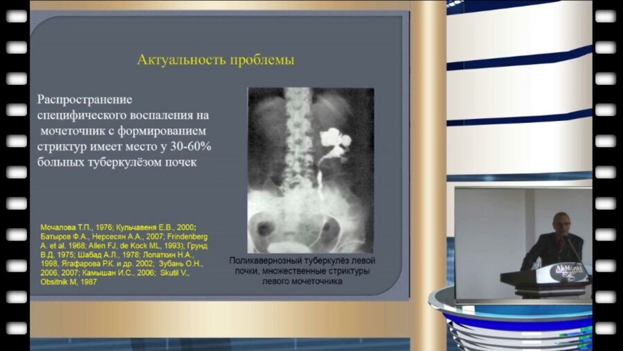 Б.И. Новиков - Сравнительная характеристика эндоскопической коррекции стриктур мочеточника туберкулезного и неспецифического генеза, осложненных и неосложненных уролитиазом