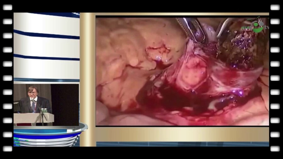 Медведев В.Л. - "Симультантные лапароскопические операции в урологии"