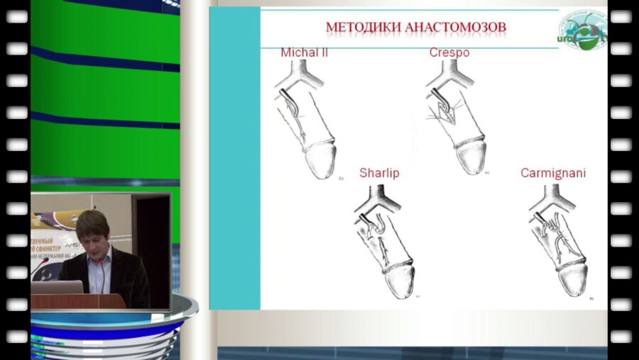 Абдулхамидов А.Н. - Реваскуляризация полового члена, 40 лет истории