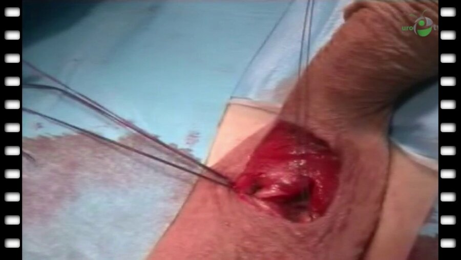 М.М. Сокольщик - Имплантация пластического протеза Spectra