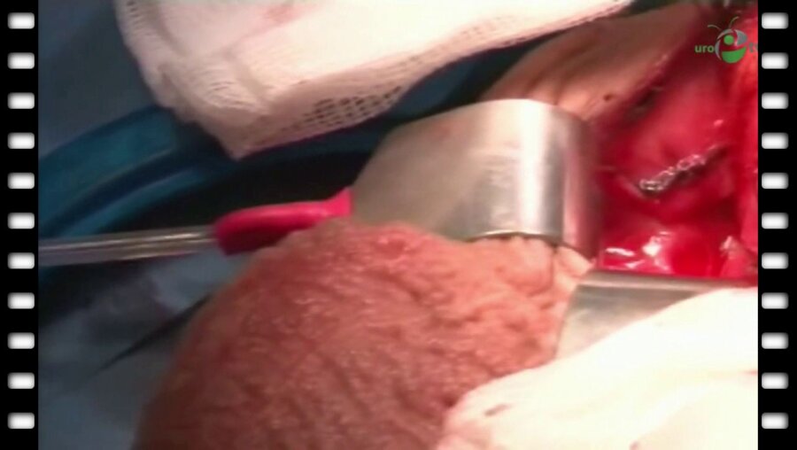 Enrique Lledo-Garcia - Имплантация 2-х компонентного эндофаллопротеза Ambicor