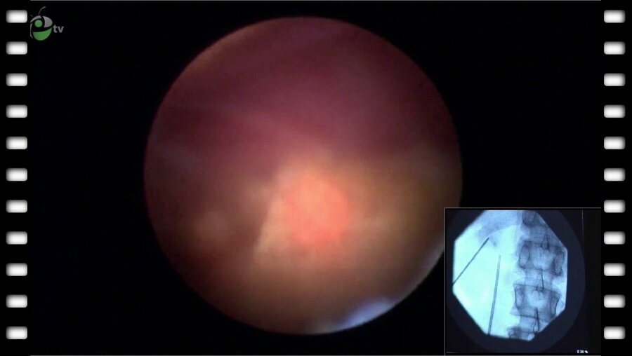 Операция "Микроперкутанная нефролитотрипсия"