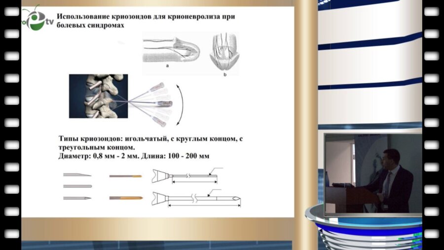 Миркин Я.Б. - Малоинвазивная криохирургия периферических нервов, как метод лечения нейропатии полового нерва, гиперактивного мочевого пузыря и преждевременного семяизвержения