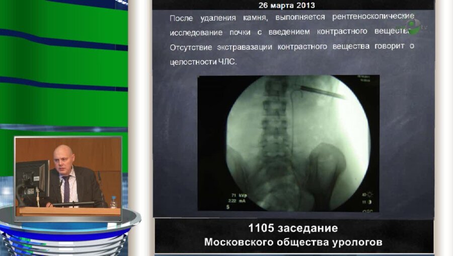 Арустамов Л.Д. "Бездренажная перкутанная нефролитотрипсия в лечении пациентов с МКБ"