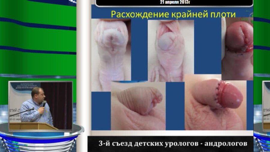 Каганцов И.М. "Осложнения пластики крайней плоти при коррекции дистальной гипоспадии у детей"