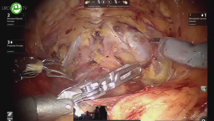 Роботическая радикальная простатэктомия. Мосоян М.С.