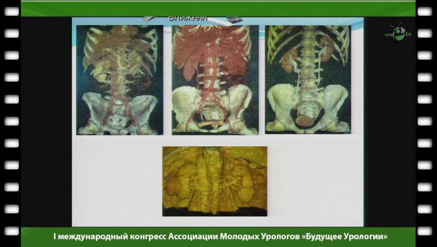 Токтабаянов Б.Г. - "Перкутанная эндоскопическая ретроперитонеальная криоаблация опухолей почек"