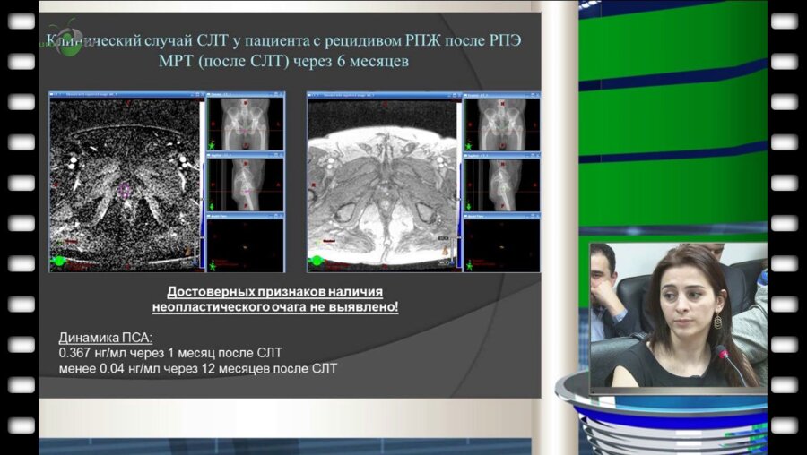 Ахвердиева Г.И.  - "Мультипараметрическая МРТ в диагностике рецидивов рака предстательной железы"