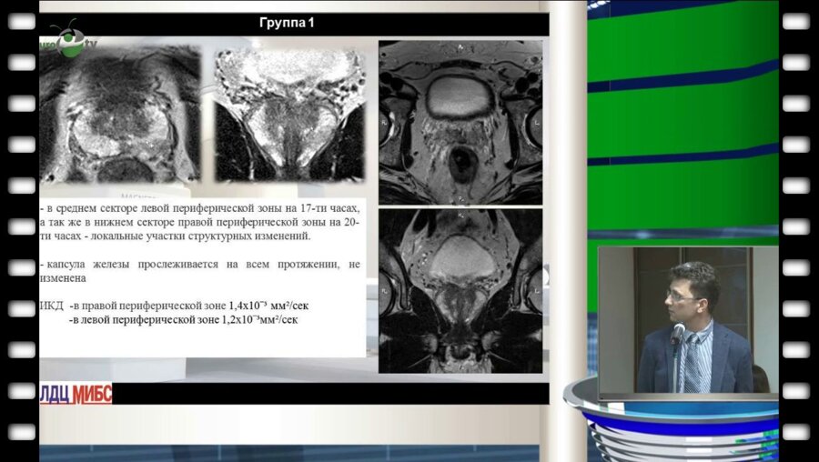 Куплевацкий В.И.  - "Роль МРТ технологии в малоинвазивной диагностике локализованного рака предстательной железы"