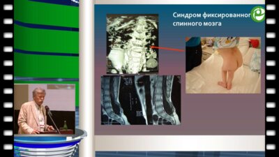 Николаев С.Н. - Ботулинотерапия нейрогенной дисфункции мочевого пузыря детей с синдромом спинального дизрафизма