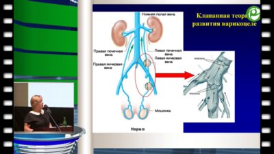 Меновщикова Л.Б. - Обоснование диагностического и лечебного протокола при варикоцеле у детей и подростков