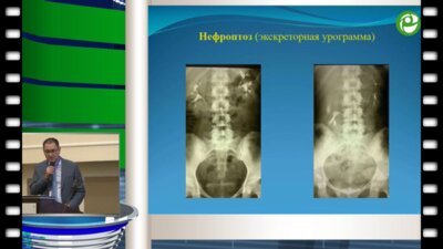 Муратов Т.М. - Наш опыт лапароскопических операций в урологии