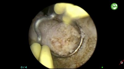 Операция "Биполярная ТУР простаты"