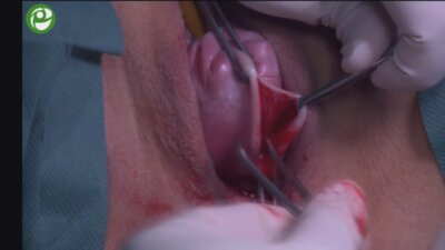 Реконструкция тазового дна при цистоцеле 3 ст. с апикальным пролапсом 3-4 ст.