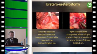 Лапароскопическая коррекция ятрогенных стриктур мочеточника