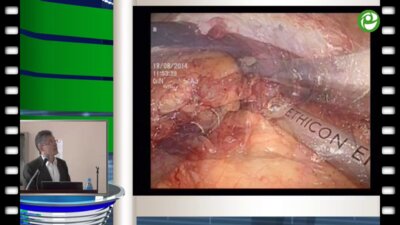 Сергеев В.П. - Левосторонняя циторедуктивная нефрэктомия с резекцией грудины, оментопластикой и аллопротезированием