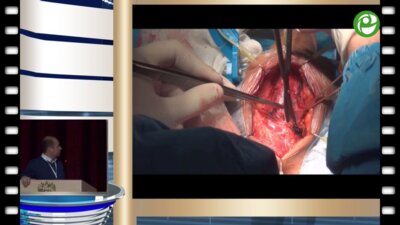 Бутнару Д.В. - Буккальная мышце-нервсберегающая пластика стриктуры бульбозного отдела уретры