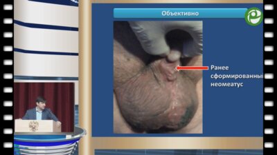 Глухов В.П. - Гипоспадия. Осложнённый калькулезный дивертикул неоуретры. Уретропластика