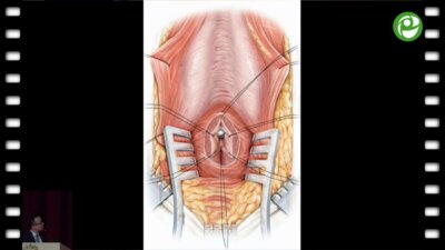 Гуспанов Р.И. - Решения в сложных случаях при выполнении бульбо-простатического анастомоза