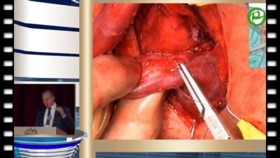 Котов С.В. - Анастомотическая уретропластика без пересечения спонгиозного тела