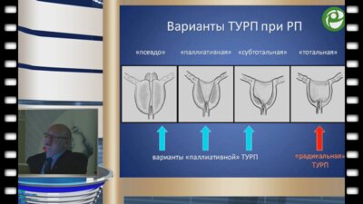 Мартов А.Г. - Трансуретральная простатвезикулэктомия в лечении рака предстательной железы