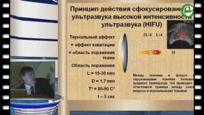 Уренков С.Б. - HIFU-терапия рака предстательной железы