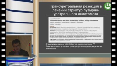 Холтобин Д.П. - Опыт позадилонного лечения облитерации уретроцистоанастомоза после радикальной простатэктомии