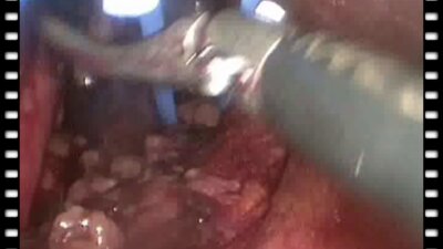 Гулиев Б.Г. - Лапароскопическая геминефрэктомия справа