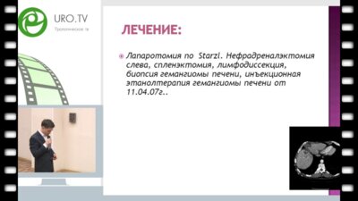Андабеков Т.Т. - Случай комбинированного лечения рака почки