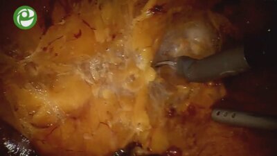 Лапароскопическая роботизированная нервосберегающая радикальная простатэктомия