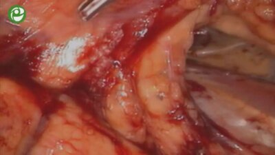 Радикальная нефрэктомия слева. Герниопластика