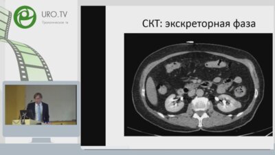 Ретроперитонеоскопическая резекция почки с опухолью