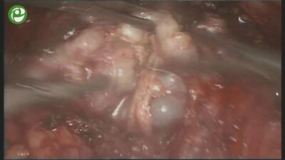 Экстраперитонеальная видеоэндоскопическая радикальная нервсберегающая простатэктомия