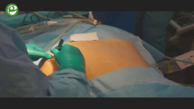 Лапароскопическая радикальная нефрэктомия