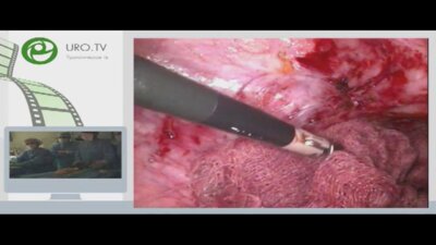 Лапароскопическая пластика мочеточника по Боари