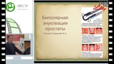 Нотов К.Г. - Место эндоскопической энуклеации в хирургическом лечении ДГПЖ
