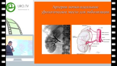 Жуков О.Б. - Рентгенэндоваскулярный гемостаз и химиоэмболизации у онкоурологических больных