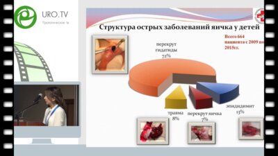 Гасанова Е.Н. - Дифференцированное лечение перекрута гидатиды у детей