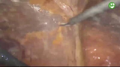 Лапароскопическая нефрэктомия справа