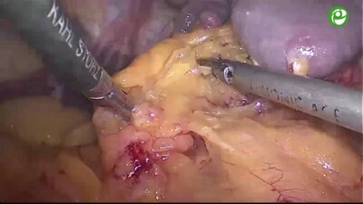 Лапароскопическая резекция левой почки