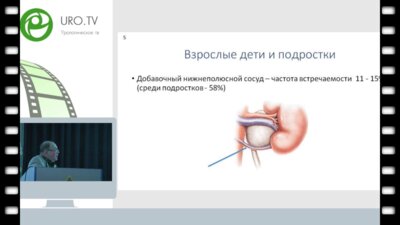 Коварский С.Л. - Опыт применения неразобщающей пиелопластики при гидронефрозе у детей