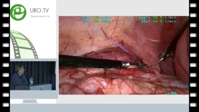Бондаренко С.Г. - Лапароскопическая геминефрэктомия. Оперативные нюансы