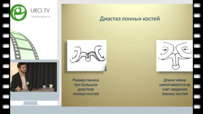 Алиев Д.К. - Методы удлинения кавернозных тел у детей с эписпадией и экстрофией мочевого пузыря